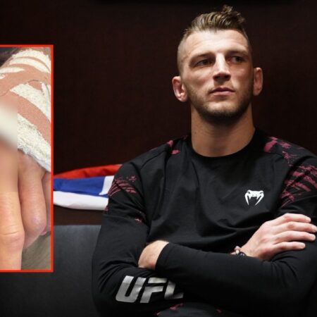 Dan Hooker Shares Grisly Hand Surgery Stitch Removal Video