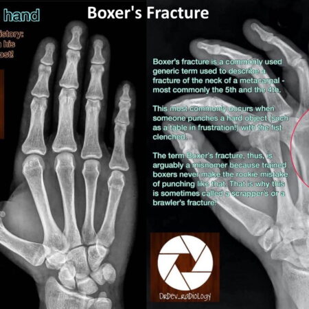Beauden Barrett’s Recurring Nightmare: Hand Fracture Strikes Again